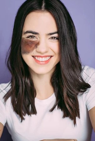 A woman smiling with a bruise on her left cheek, set against a purple background.